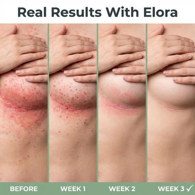 Elora Intertrigo Relief Cream