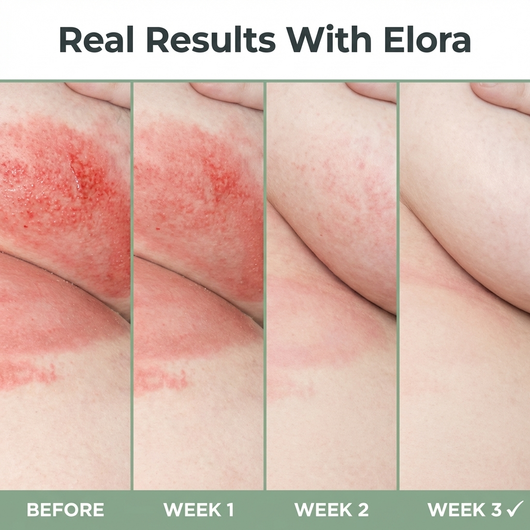 Elora Intertrigo Relief Cream