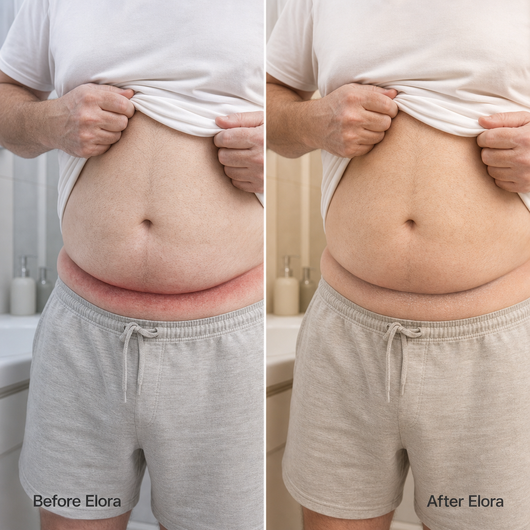 Elora for Men - Intertrigo Relief Cream